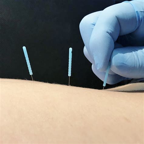 physical therapist in mooresville dry needling in mooresville k2 sports therapy and performance