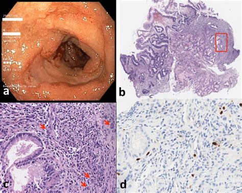 A Upper Endoscopy Showing Multiple Large And Confluent Ulcers In The Download Scientific