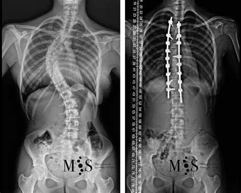 Scoliosis Surgery Morgenstern Institute Of Spine