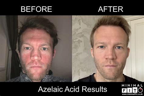 Acid Before And After