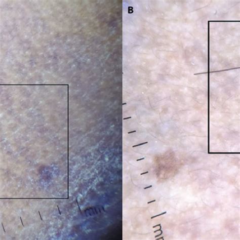 Dermoscopic Image Revealing Blue Gray Pigmentation Forming A
