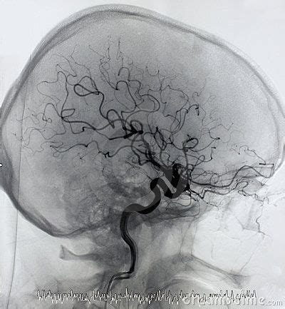 Brain Angiography Arteriography By Vesna Njagulj Via Dreamstime Human