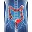 Colon Cancer Artwork  Stock Image F006/2211 Science Photo Library