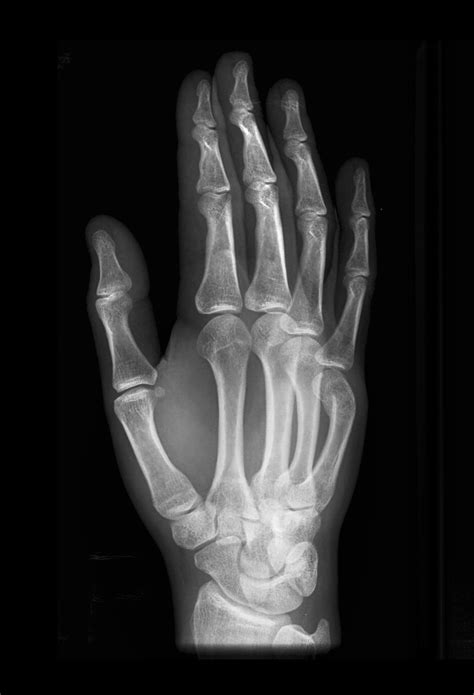 Boxer Fracture Image