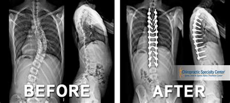 chiropractic physiotherapy or scoliosis surgery in malaysia