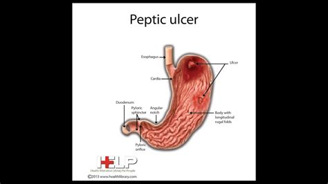 Peptic Ulcer Part 1 Stomach Anatomy Pathophysiology Symptoms Diagnosis Youtube