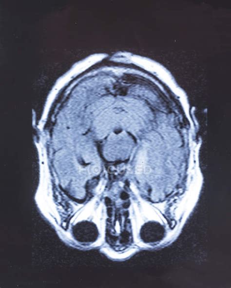 Magnetic Resonance Imaging Scan Of Human Brain — Oncology Radiography