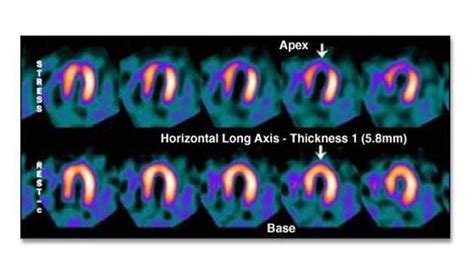 Should i get a nuclear stress test? Cardiac Imaging at New York College of Osteopathic ...
