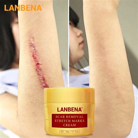 Lanbena Scar Removal Cream Acne Treatment Repairing Scar Shopee Singapore