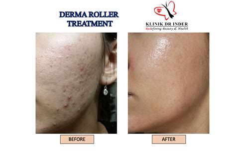 Derma Roller Treatment Anti Aging Aesthetic Clinic Malaysia