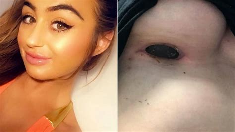 Woman Claims Implant Scar Smelled Like Rotten Meat After Botched