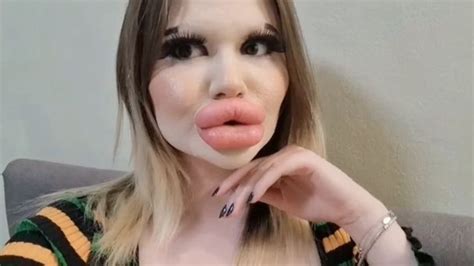Woman With World S Biggest Lips Wants Huge Cheekbones Too