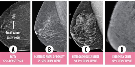 Dense Breasts Canada Know And Understand Your Breast Density