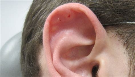 Nodule On Scaphoid Fossa Of The Ear Clinical Advisor