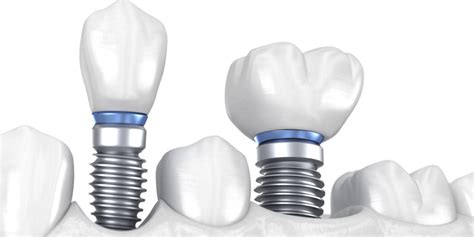 Full mouth dental implant costs with dental insurance are lofty enough to illustrate two opposite consequences of consolidated spending. Single & Multiple Dental Implants | The Bronx, New York
