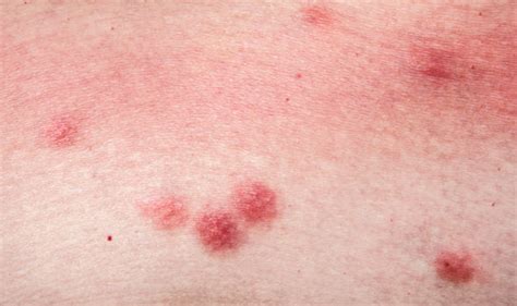 Bed Bug Bites Signs Youve Been Bitten And How To Get Rid Of An