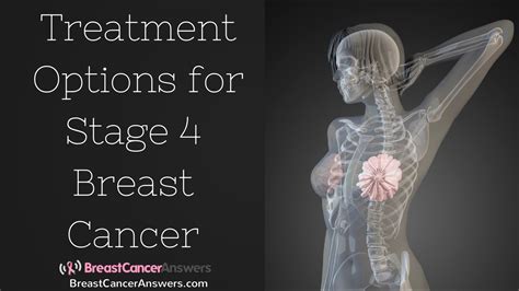 What Are The Treatment Options For Stage 4 Breast Cancer Youtube