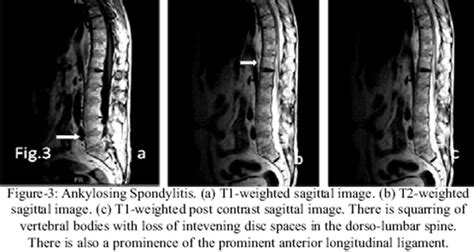 Spinal Changes In Patients With Ankylosing Spondylitis On Mri Case Series