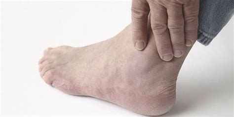 Ankle Osteoarthritis Symptoms Types How To Treat With Medication