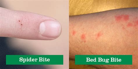 Spider Bite Vs Bed Bug Bite Green Pest Solutions