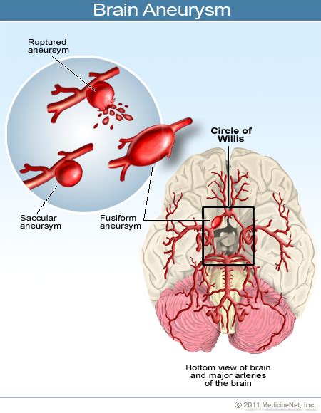 Un aneurisma cerebral (también llamado aneurisma intracraneal o aneurisma cerebral) es un área protuberante y debilitada en la pared de una arteria en el cerebro, que produce ensanchamiento o distensión anormal. Brain Aneurysm. Causes, symptoms, treatment Brain Aneurysm