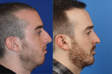 When To Choose A Nose Tip Surgery Over Full Rhinoplasty Philip Miller Md