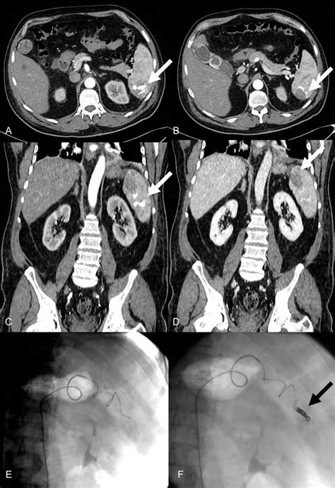 Contrast Enhanced Ct In The Arterial A And Venous Phases B In The