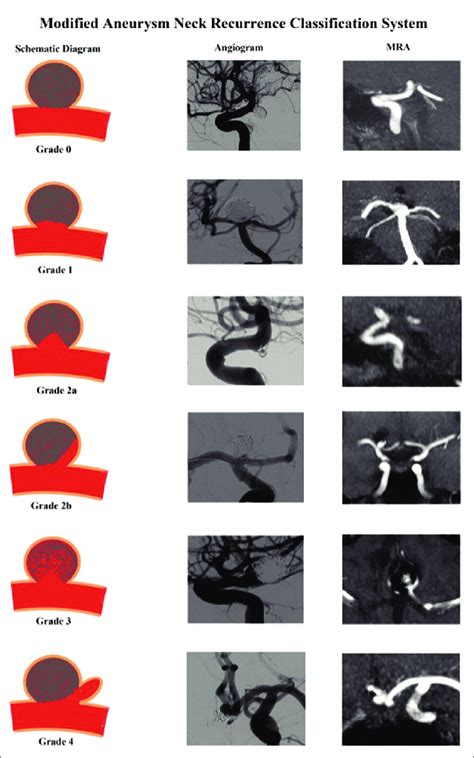 Raymond Roy Aneurysm Neck Recurrence Classification System Figure 2 A
