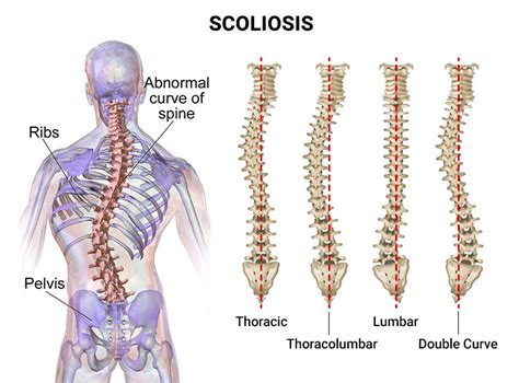 Scoliosis Doctors In Nj Nyc Scoliosis Treatment Specialists