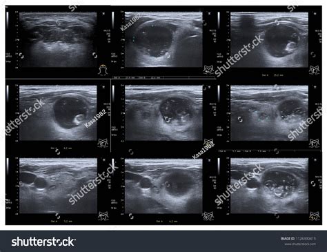 Ultrasound Thyroid Impression Sp Left Thyroidectomymultinodular Stock