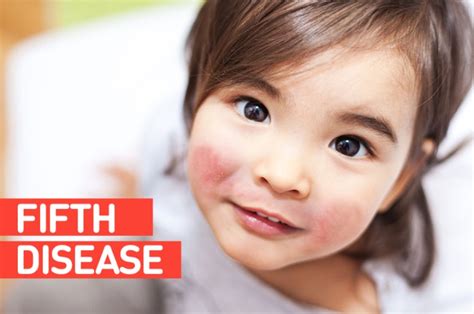 How To Manage A Child Suffering From Fifth Disease Diagnosis And