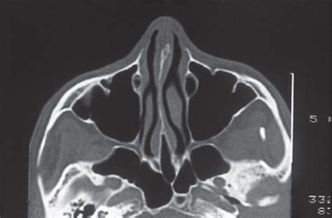 Surgical Anatomy Of The Paranasal Sinus Ento Key