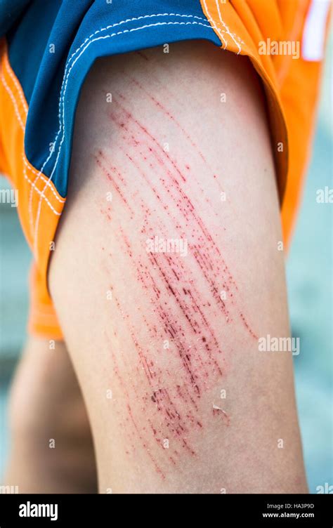 Skin Scrape Knee Child Hi Res Stock Photography And Images Alamy