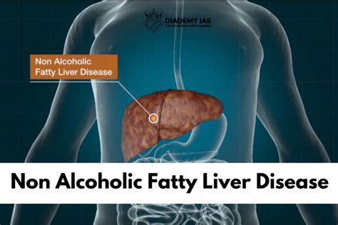 What Is Non Alcoholic Fatty Liver Disease Diademy Ias