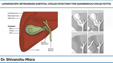 Laparoscopic Retrograde Subtotal Cholecystectomy For Gangrenous