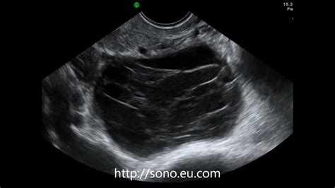 Hemorrhagic Ovarian Cyst On Transvaginal Ultrasound Youtube Hot