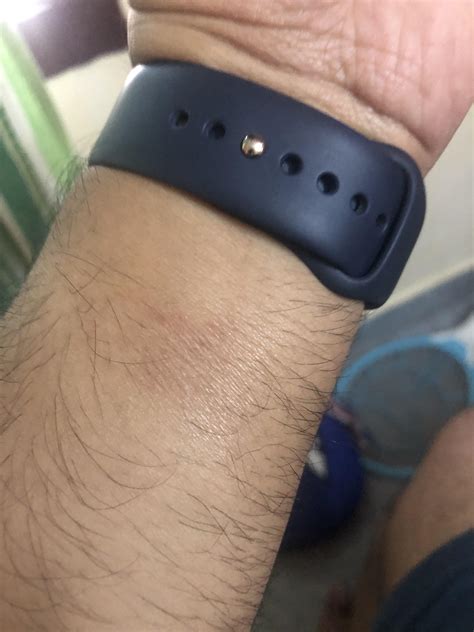 Experiencing Rashes For The 1st Time After Almost 5 Years Of Apple