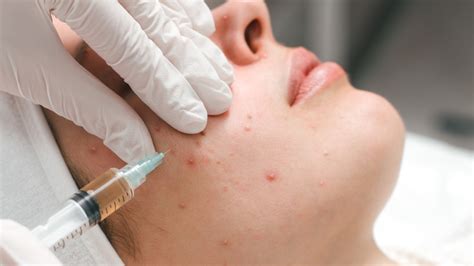 Filler As An Acne Scar Treatment What You Need To Know Before Trying