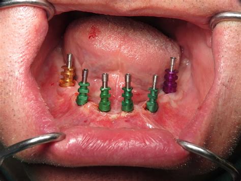 All On Dental Implants With Prettau Solid Zirconia Dental Implant Bridges ~a Case Explained