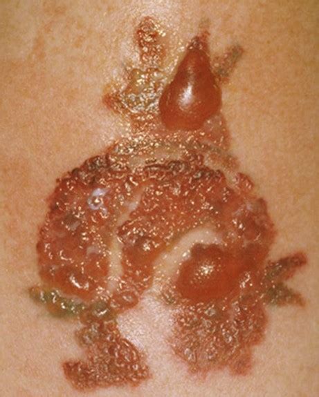 What is a tattoo infection? Tattoo Infection - Pictures, Signs, Symptoms, Causes, Treatment