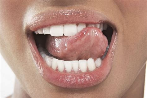 Dry Mouth Symptoms Of Dry Mouth