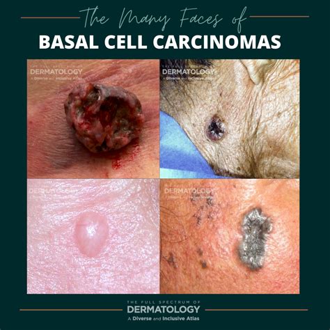 The Many Faces Of Basal Cell Carcinomas Bccs Next Steps In Dermatology
