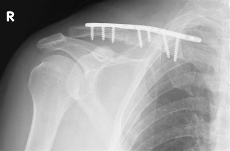 The Radiograph Of The Clavicle After Surgery Shows That The Malunion