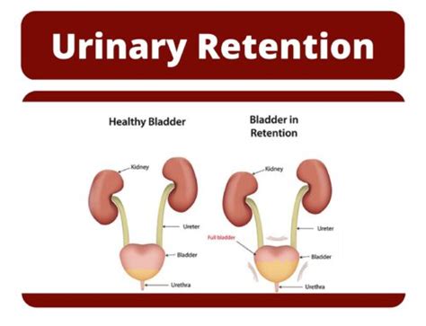 Urinary Tract Infections In Women Urolife Clinic