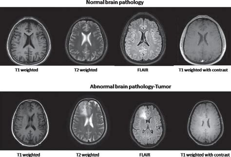 Multi Sequential Mr Brain Image Classification For Tumor Detection