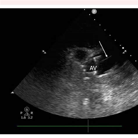 Transthoracic Echocardiography Showing The Aortic Valve And Proximal