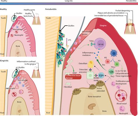 Effects Of Periodontitis On Cancer Outcomes In The Era Of Immunotherapy The Lancet Healthy