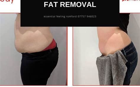 The Ultimate Guide To Non Surgical Belly Fat Removal Essex