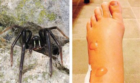 False Black Widow Spider Bites Images Latrodectus Wikipedia The