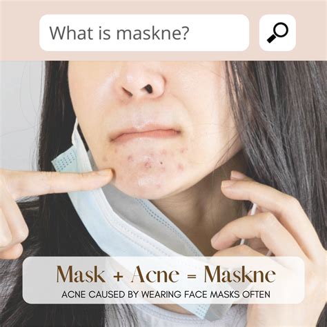 Maskne Facial Singapore All You Need To Know About Mask Acne